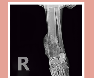 showing an X-ray of an osteosarcoma